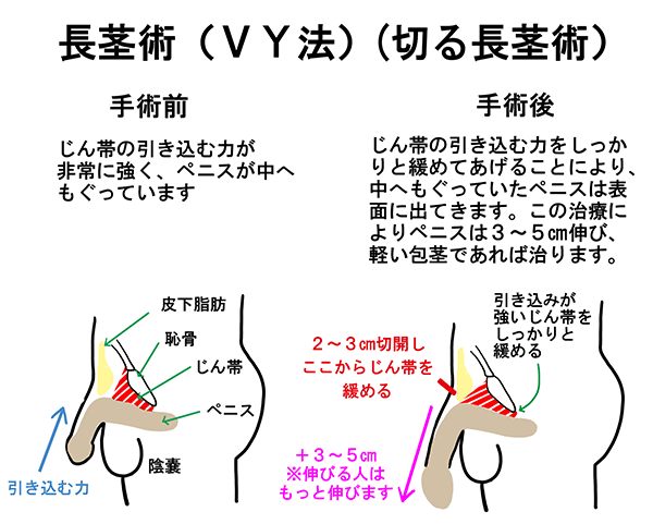 堤靭帯部分切開法（切る長茎術）の術前と術後