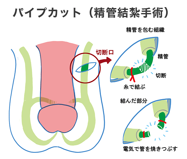 パイプカット治療内容の図