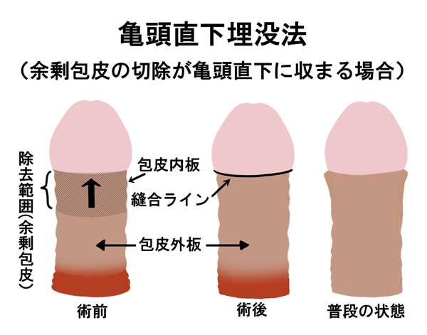 亀頭直下法とは