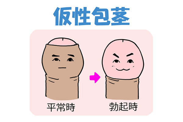 仮性包茎とは