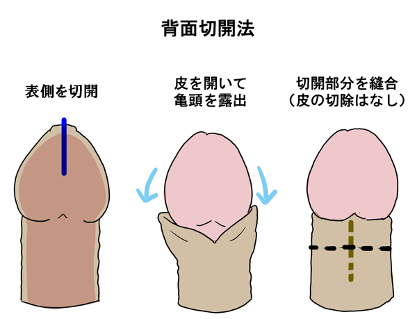 背面切開術とは