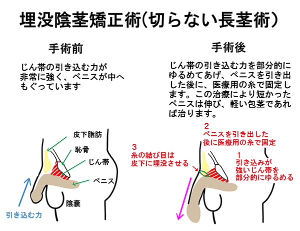 埋没陰茎矯正術（切らない長茎術）の術前と術後