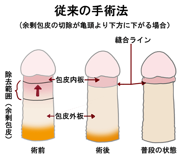 環状切除術とは