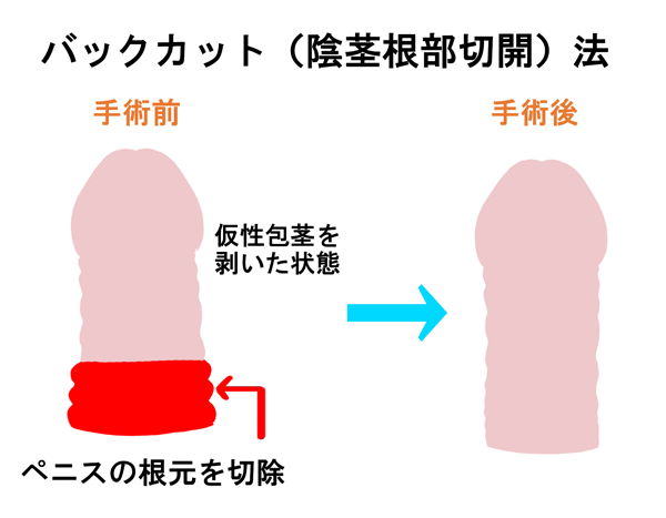 包茎手術-バックカット法とは